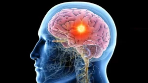 Read more about the article Understanding Epilepsy-Causes